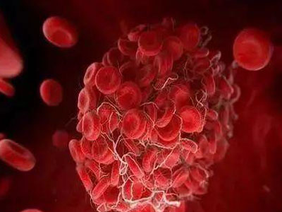 又到脑卒中高发季 你的颈动脉还好吗?