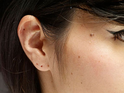 手贱把痣抠成了瘤!这些痣碰不得