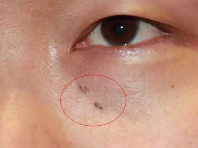 手贱把痣抠成了瘤!这些痣碰不得